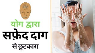 सफेद दाग का रामबाण इलाज  घरेलू उपचार  Yoga for Leucoderma in Hindi [upl. by Lundgren713]