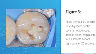 Indirect Pulp Capping Case using TheraCal LC [upl. by Jona432]