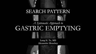 NM Gastric Emptying Study  Search Pattern [upl. by Paza]