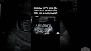 Baby movement in womb pregnancycare pregnancy ultrasound [upl. by Alyahsal]