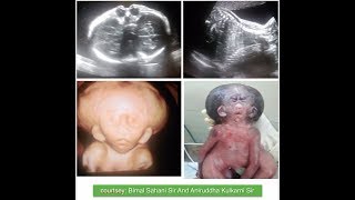 CONJOINED TWIN ULTRASOUND  CRANIOTHORACOPAGUS [upl. by Suqram]