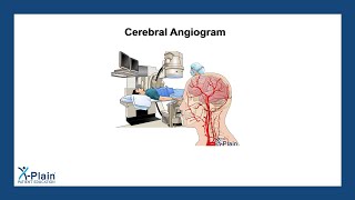 Cerebral Angiogram [upl. by Henryetta]