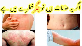 What Causes Itching in Liver Disease  Liver infection Symptoms  Liver function disorder [upl. by Sivraj]