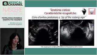 Teratomi cistici struma ovarii fibromi fibrotecomi ovarici tumore di Brenner  S Del Forno [upl. by Ettezyl]