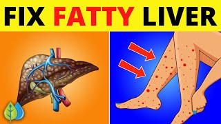 7 Signs And Symptoms Of Fatty Liver Disease amp Treatment to Reverse Naturally [upl. by Takken573]