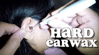 Womans Hard Earwax Removed with Few Drops of Hydrogen Peroxide [upl. by Hyland702]