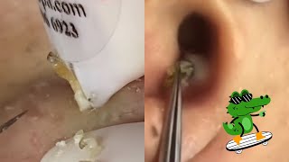 Ultimate ASMR Pimple Popping Compilation  Blackhead amp Cyst Extraction for Maximum Relaxation [upl. by Llehcor]