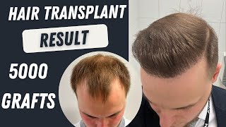 Hair Transplant Before and After 5000 Grafts Result 12 months  Hair Transplant Timelapse [upl. by Adriene54]