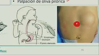 Cirugía pediátrica  Enfermedad de Hirschprung estenosis hipertrofica de piloro [upl. by Lindsey]