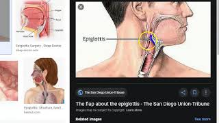 ENT 340 a Larynx Trauma Neck Trachea Injury Hurt LaryngoTracheal Fracture [upl. by Ybbed]