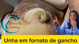 TRATAMENTO para UNHAS em GANCHO na Podologia [upl. by Huberty]