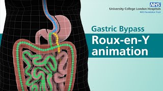 Gastric Bypass  RouxenY animation [upl. by Akenahs736]