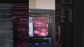 Intestinal Ascariasis Ultrasound [upl. by Amado165]