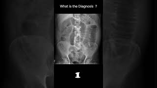 Small bowel obstruction Abdominal Xray  Abnormalities Normal reference 63 radiologychannel007 [upl. by Ati]