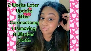 🦷Wisdom ToothCoronectomy  2 week Update 🦷😬 [upl. by Schmidt]