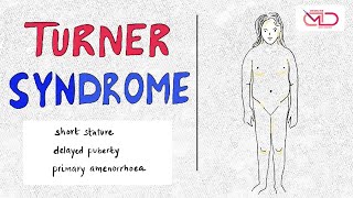 Turner Syndrome  Genetics Pathology Presentation  Dr Shonali Chandra [upl. by Nnayd]