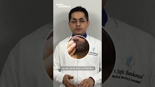 Does Minoxidil causes side effects for beard growth Listen to Beard specialist Advice [upl. by Ubald]