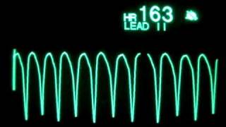 Taquicardia Ventricular  Ventricular Tachycardia [upl. by Niarfe]