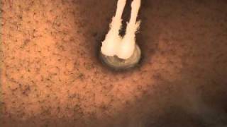 NonSurgical Keloid Treatment with Cryotherapy [upl. by Norbert641]