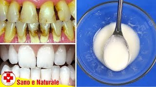 Come Rimuovere Il Tartaro In 2 Minuti  Utilizza Questa Miscela Per Avere Denti Bianchi Naturali [upl. by Marin]