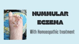 Numular eczema [upl. by Aidualc490]