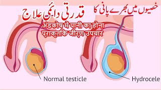 Get Permanant Relief from Hydrocele  Natural Treatment of Hydrocele [upl. by Bunny]