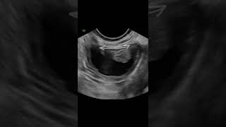 3 Advanced Ovarian Cyst Ultrasound Features to Master ultrasound ovariancyst [upl. by Naltiac]