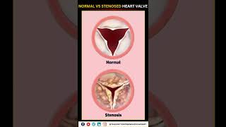 Normal vs Narrowed Stenosed Heart Valve education neet biology heart [upl. by Girardi829]