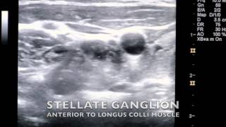 Ultrasound Guided Stellate Ganglion Block [upl. by Oitaroh395]