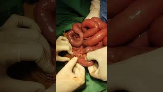 Intestinal obstruction due to Meckel diverticula band [upl. by Mulcahy815]