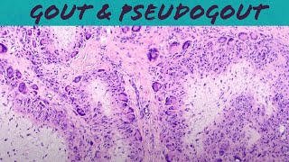 Gout amp Pseudogout calcium pyrophosphate deposition disease  chondrocalcinosis pathology USMLE [upl. by Nortna]