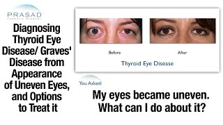 Thyroid Problems can Cause Uneven Eyes  Diagnosis and Eye Surgery Important Before Cosmetic Surgery [upl. by Anires]