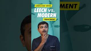 Can Leech Therapy REALLY Cure Varicose Veins [upl. by Ativahs51]