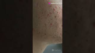 Should You Get Extractions with AcnePro 20240623 acne acnescars estheticianextractions [upl. by Annayr729]