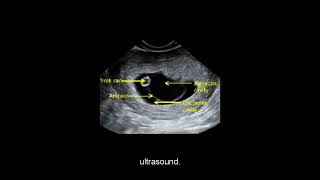 Ultrasound of the first trimester Part 1 Level 1 [upl. by Yorel]