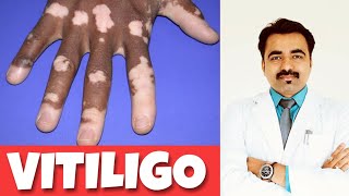 VITILIGO Leucoderma WHITE PATCHES Hindi [upl. by Astera]