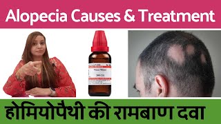 Alopecia Areata treatment  alopecia ka ilaj  alopecia areata homeopathic treatment in hindi [upl. by Marx]