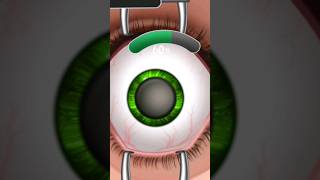 3D Animation LASIK eye surgery subscribe animation gaming [upl. by Anesusa323]