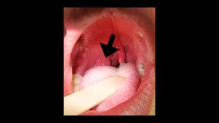 Complication of Tonsillitis Quinsy aka Peritonsillar abscess mbbs next [upl. by Vittoria748]