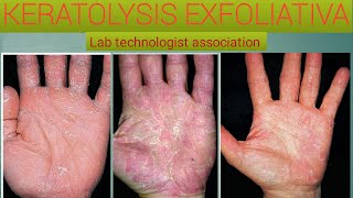 Everything you know about keratolysis exfoliativa [upl. by Airasor]