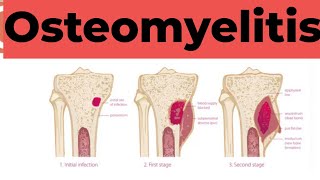 Osteomyelitis  Causes Sign and Symptoms Diagnosis amp Treatment Pathology [upl. by Nosduh705]