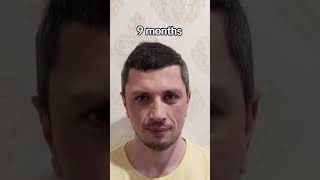 Hair Transplant Result  Hair Transplant Time lapse  Hair Transplant in Turkey [upl. by Seyah43]