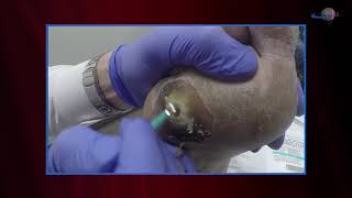 WCW Managing Diabetic Foot Ulcers  Debridement and Classifying Ulcers [upl. by Anirtak]