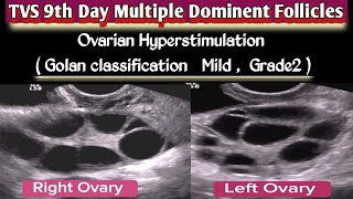 Ovarian Hyperstimulation  OHSS   TVS Multiple Dominant Follicles  Complications  Risk Factors [upl. by Frazer]