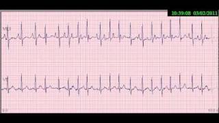 06TAQUICARDIA ATRIAL UNIFOCAL [upl. by Jessika54]