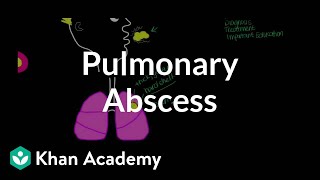 Pulmonary abscess  Respiratory system diseases  NCLEXRN  Khan Academy [upl. by Domel]