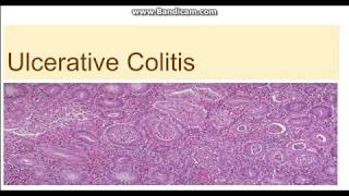 Crohn’s Disease and Ulcerative Colitis Update Latest Treatment Options [upl. by Etteyafal470]