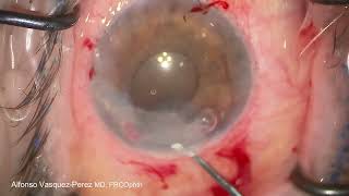 Customised DMEK to treat bullous keratopathy due to iris cyst [upl. by Adnolahs]