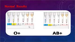 ABO discrepancy and transfusion practice part one By Dr Mohamed Samir [upl. by Busiek219]