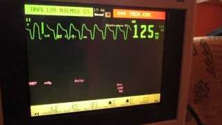 EKG Monitor [upl. by Naval]